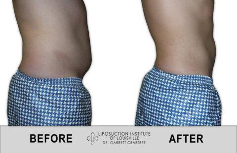 Liposuction Institute of Louisville – Male Abdomen Before After 006