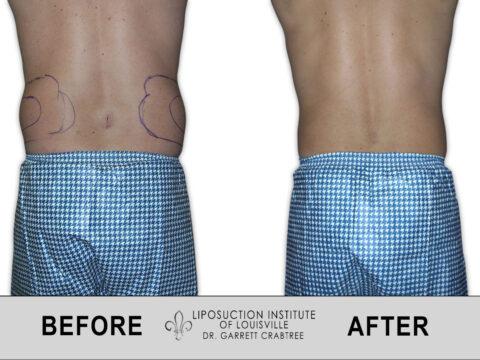 Liposuction Institute of Louisville – Male Abdomen Before After 007