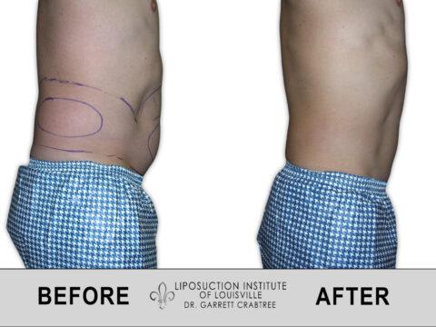 Liposuction Institute of Louisville – Male Abdomen Before After 008