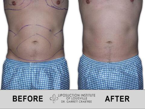 Liposuction Institute of Louisville – Male Abdomen Before After 009