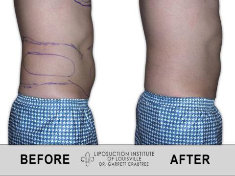 Liposuction Institute of Louisville – Male Abdomen Before After 010