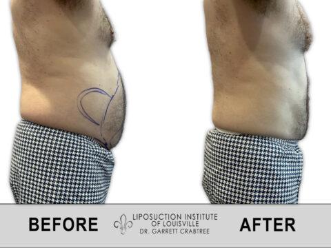 Liposuction Institute of Louisville – Male Abdomen Before After 011
