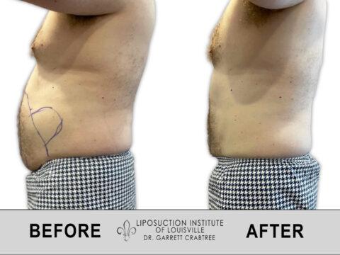 Liposuction Institute of Louisville – Male Abdomen Before After 012