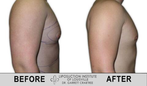 Liposuction Institute of Louisville – Male Chest Before After 001