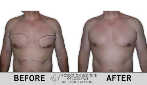 Liposuction Institute of Louisville – Male Chest Before After – Gynecomastia 002