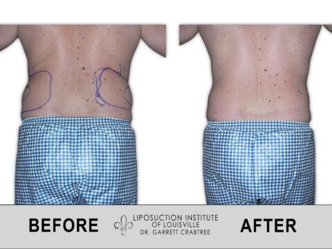 Liposuction Institute of Louisville – Male Love Handles Before After 001