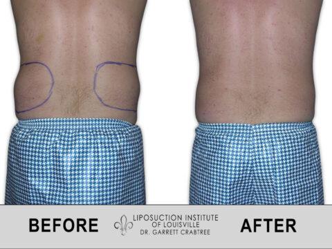 Liposuction Institute of Louisville – Male Love Handles Before After 002