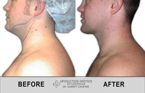 Liposuction Institute of Louisville – Male Neck Before After 001